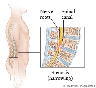 Lumbar spinal stenosis 