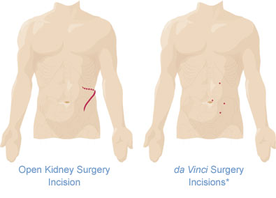 Graphic comparing incisions between daVinci and standard surgery